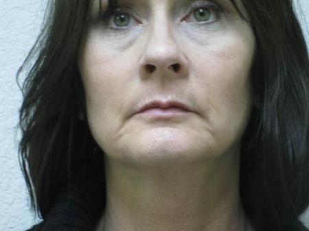 Lip Augmentation - Patient 2 - Before Image 7