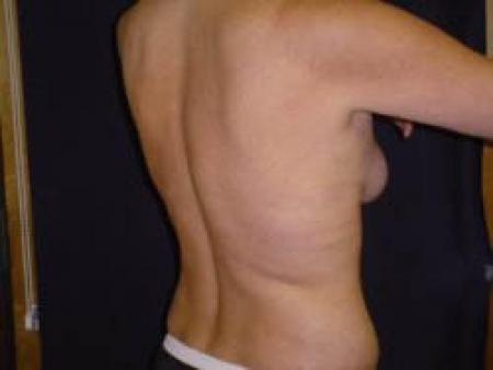 Liposuction - Patient 8 - After Image 6