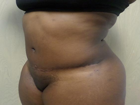 Liposuction: Patient 14 - Before 2