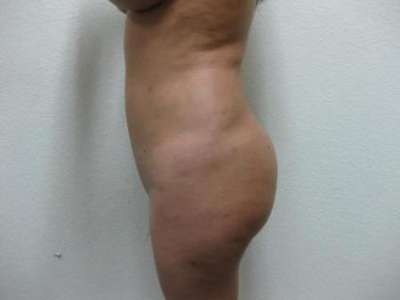 Brazilian Butt Lift - Patient 3 - Before Image 3