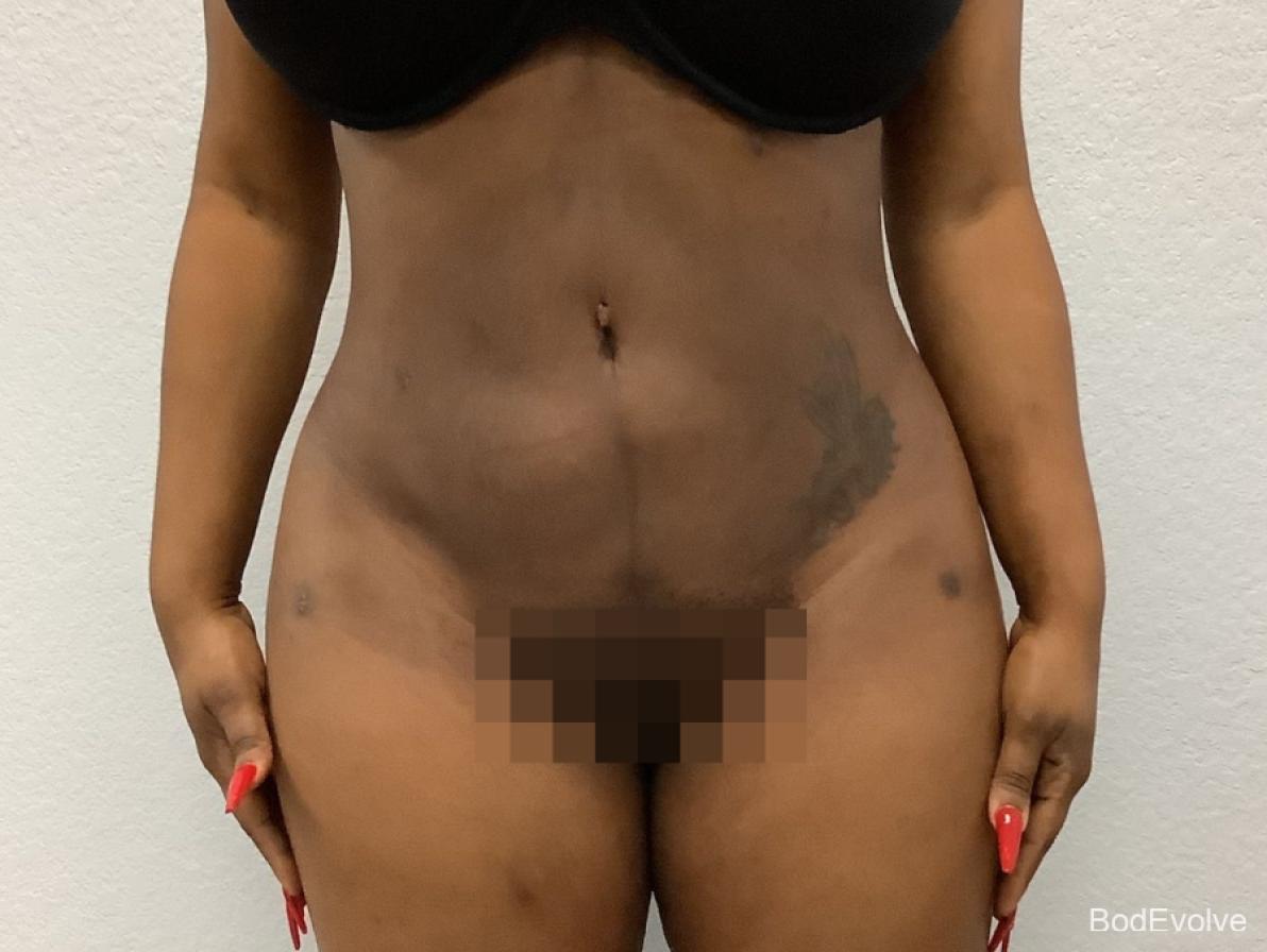Brazilian Butt Lift: Patient 2 - After  