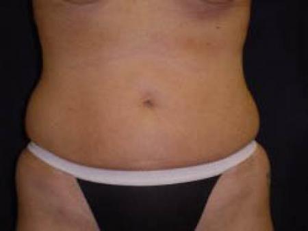 Liposuction - Patient 8 - After 