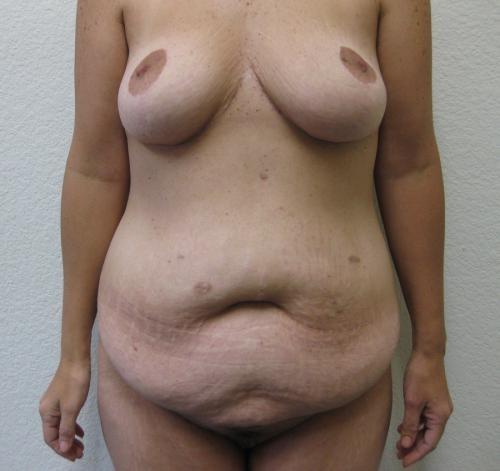 Patient 23 - Cosmetic Surgery After Massive Weight Loss - Before