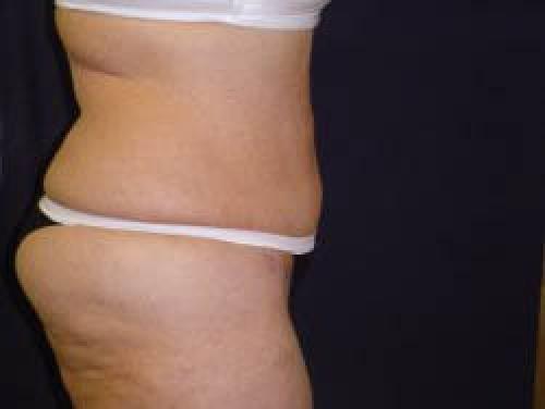 Liposuction - Patient 11 -  After 3