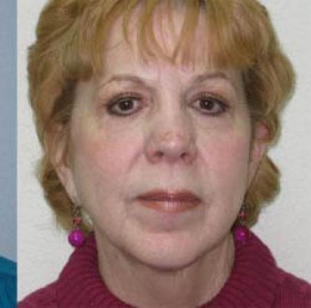 Facelift - Patient 1 - After Image 3