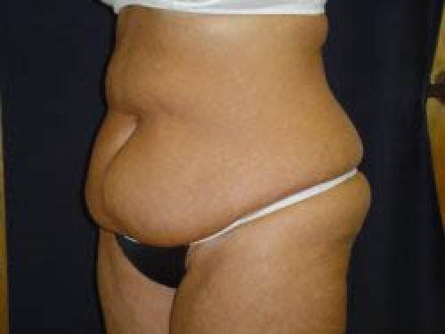 Liposuction - Patient 11 - Before 2