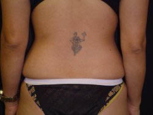 Liposuction - Patient 7 - Before