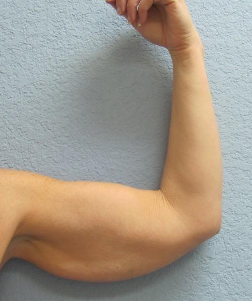 Arm Lift Surgery - Patient 3 - Before