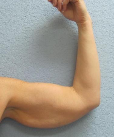 Arm Lift Surgery - Patient 3 - Before Image 1