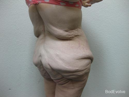 Patient 6 - Cosmetic Surgery After Massive Weight Loss - Before 7