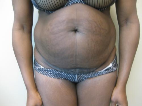 Tummy Tuck - Patient 5 - Before 1