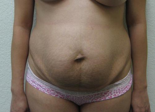 Tummy Tuck - Patient 12 - Before 1