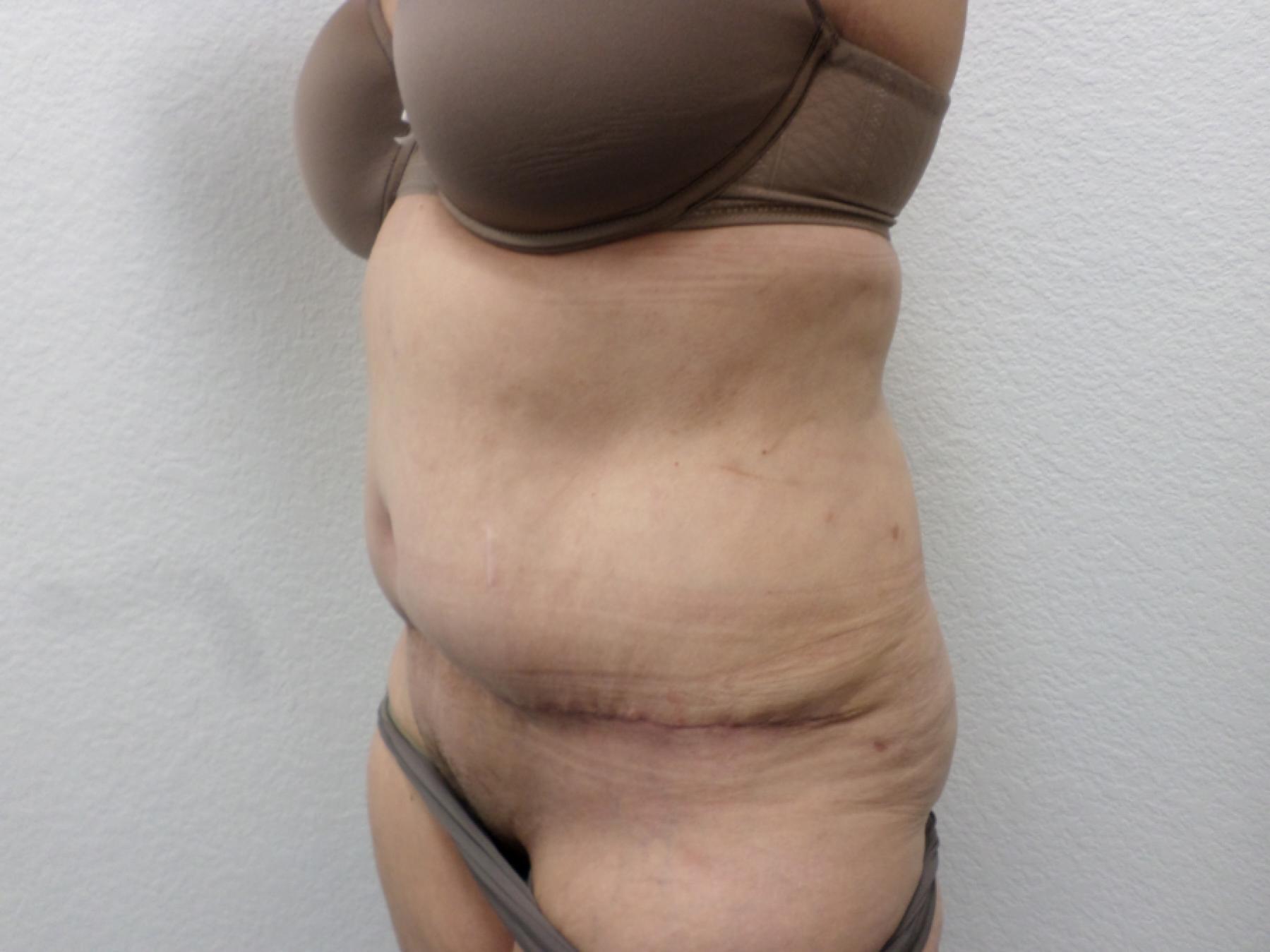 Tummy Tuck: Patient 29 - After 2