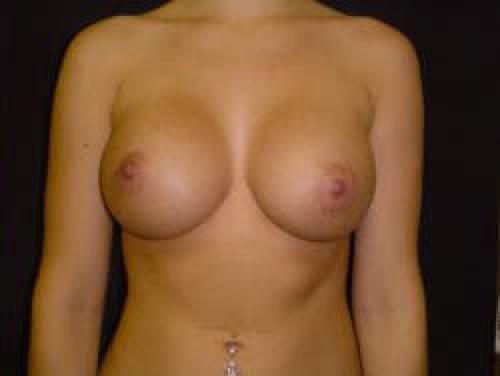 Breast Augmentation - Patient 15 -  After 1