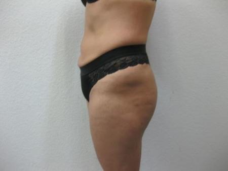 Brazilian Butt Lift - Patient 4 - After Image 4
