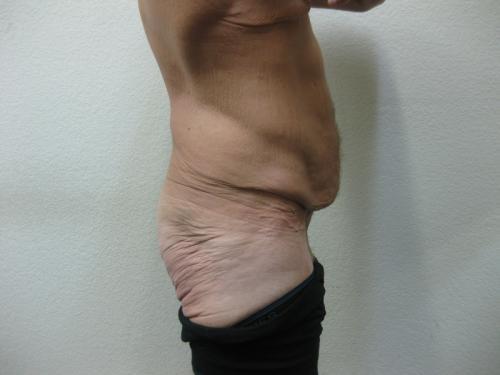 Body Lift - Patient 5 - Before and After 7