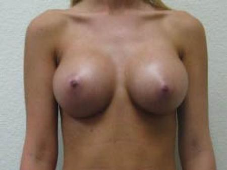 Breast Augmentation - Patient 10 - After 