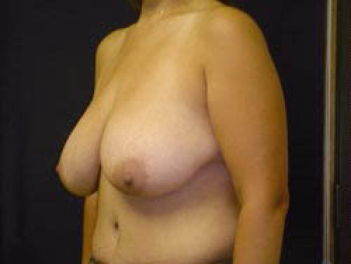 Breast Augmentation with Lift - Patient 9 - Before 2