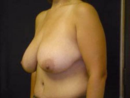 Breast Augmentation with Lift - Patient 9 - Before Image 2