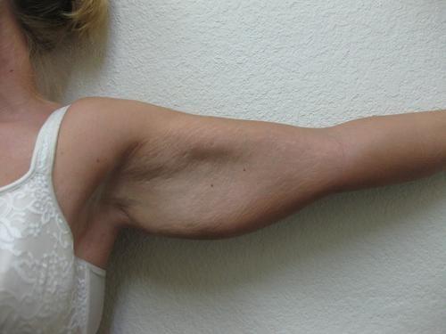 Arm Lift Surgery - Patient 1 - Before 2