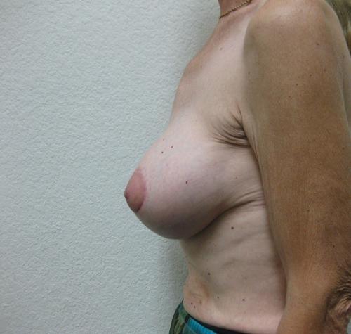 Breast Augmentation with Lift - Patient 11 -  After 3