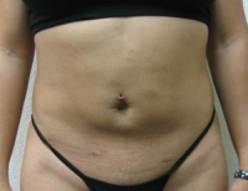 Liposuction - Patient 12 -  After 1