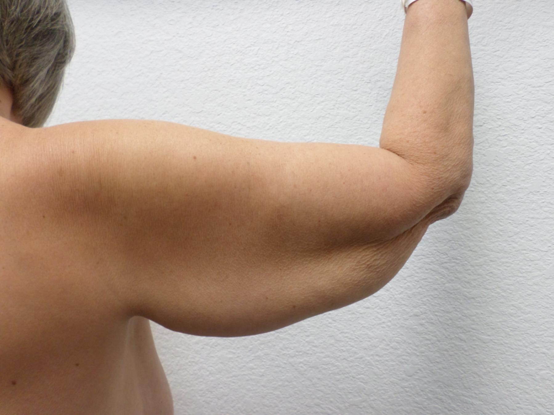 Arm Lift: Patient 9 - Before and After 8