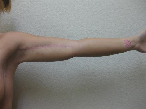 Arm Lift Surgery - Patient 1 -  After 4