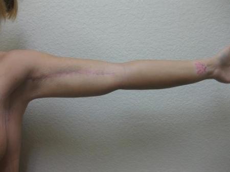 Arm Lift Surgery - Patient 1 - After Image 4