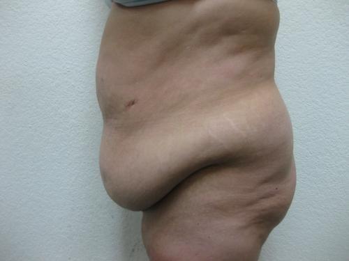Patient 10 - Cosmetic Surgery After Massive Weight Loss - Before 3