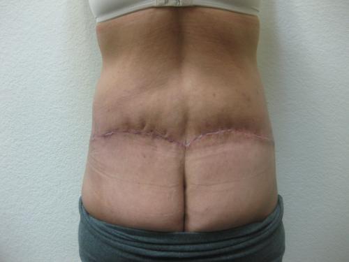Patient 25 - Cosmetic Surgery After Massive Weight Loss -  After 5