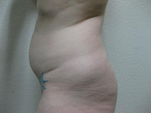 Liposuction - Patient 5 - Before 5