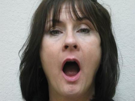 Lip Augmentation - Patient 2 - Before Image 5