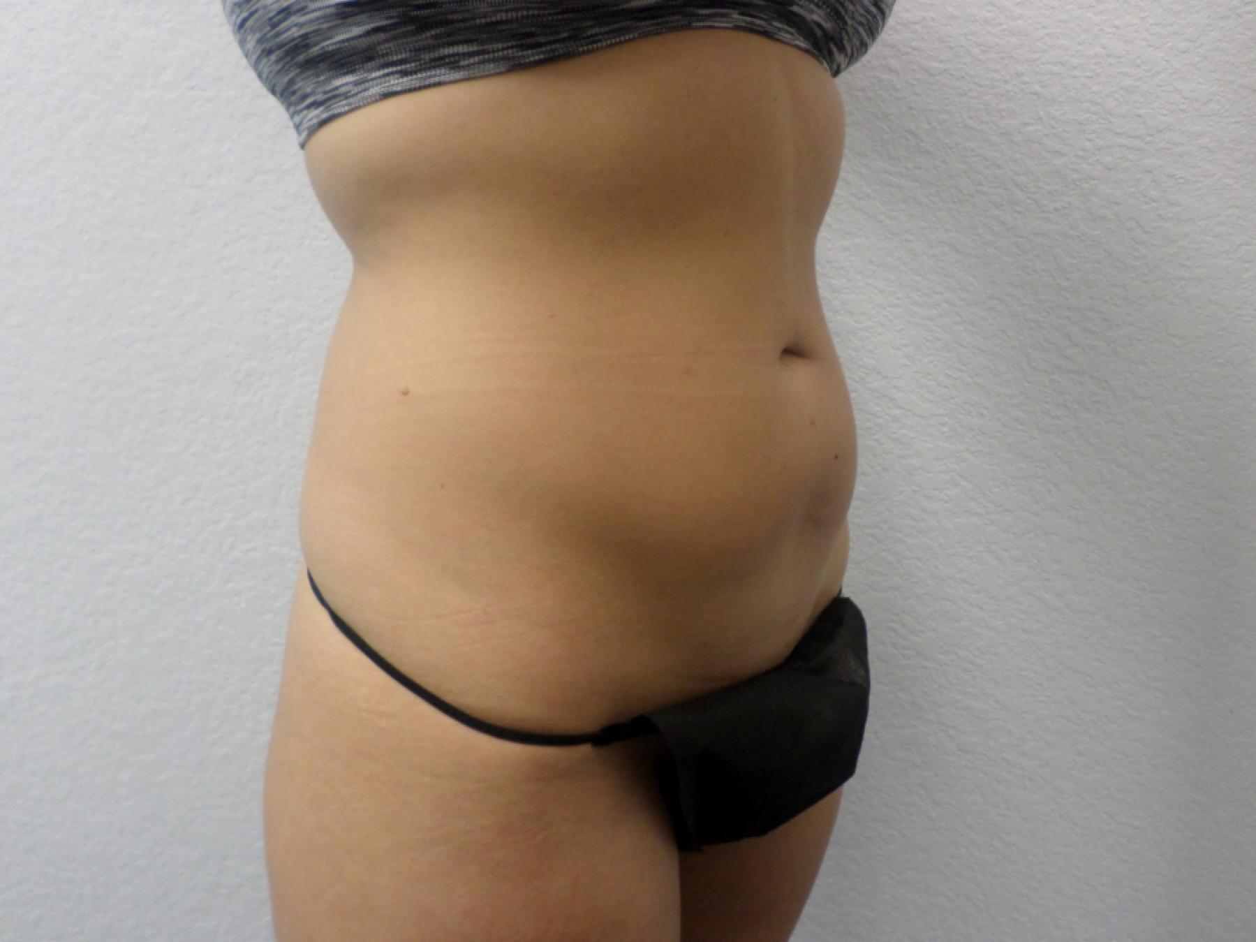 Liposuction: Patient 15 - Before 1