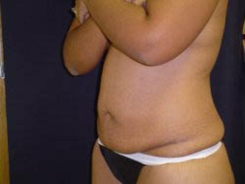 Tummy Tuck - Patient 9 - Before 2