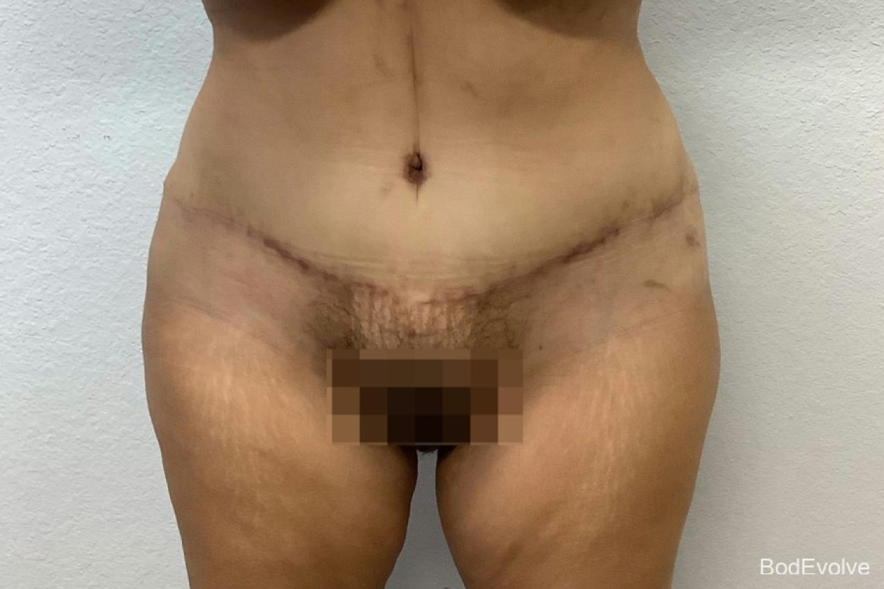 Tummy Tuck: Patient 5 - After 1