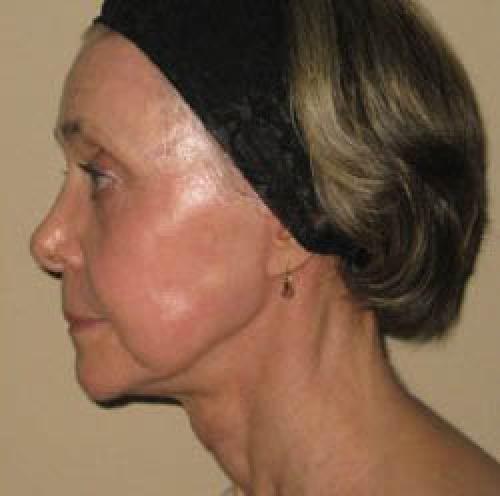 Facelift - Patient 2 - After 