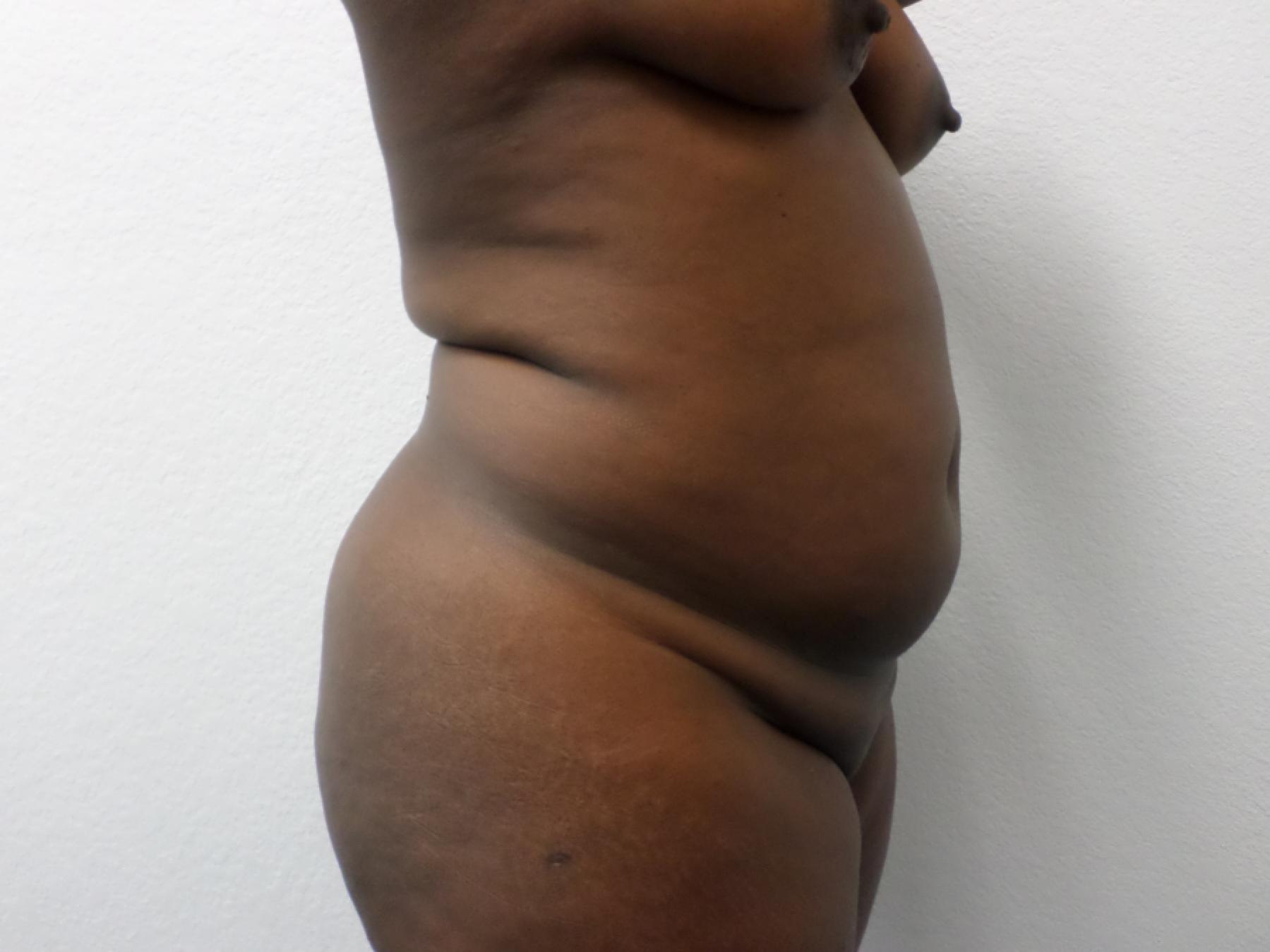 Liposuction: Patient 14 - Before 4