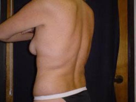 Liposuction - Patient 8 - Before Image 3