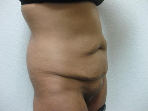Patient 8 - Cosmetic Surgery After Massive Weight Loss - Before 5