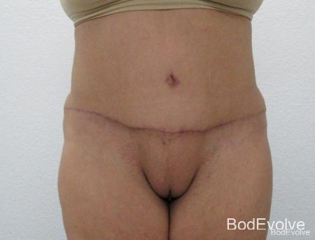 Tummy Tuck: Patient 7 - After  