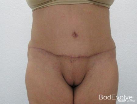 Tummy Tuck: Patient 12 - After 1