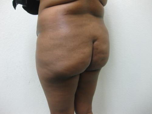 Brazilian Butt Lift - Patient 5 - Before 3