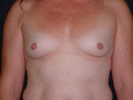 Breast Augmentation - Patient 9 - Before