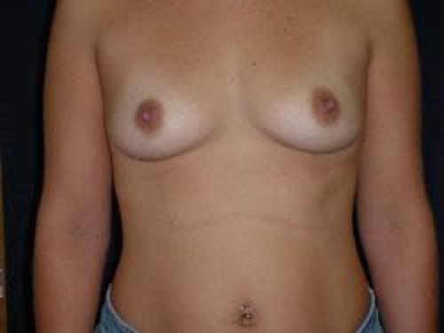 Breast Augmentation - Patient 19 - Before 1