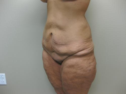 Patient 25 - Cosmetic Surgery After Massive Weight Loss - Before 2
