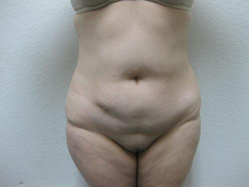 Liposuction - Patient 3 - Before 1