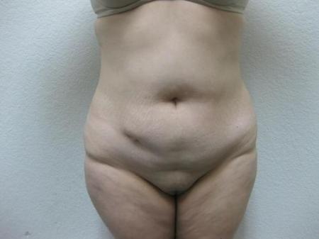 Liposuction - Patient 3 - Before