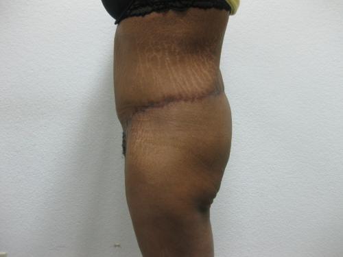 Body Lift - Patient 6 - After 4