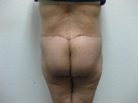 Body Lift - Patient 7 - After Image 4
